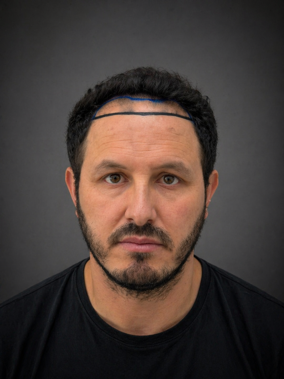 Before the hair transplant procedure