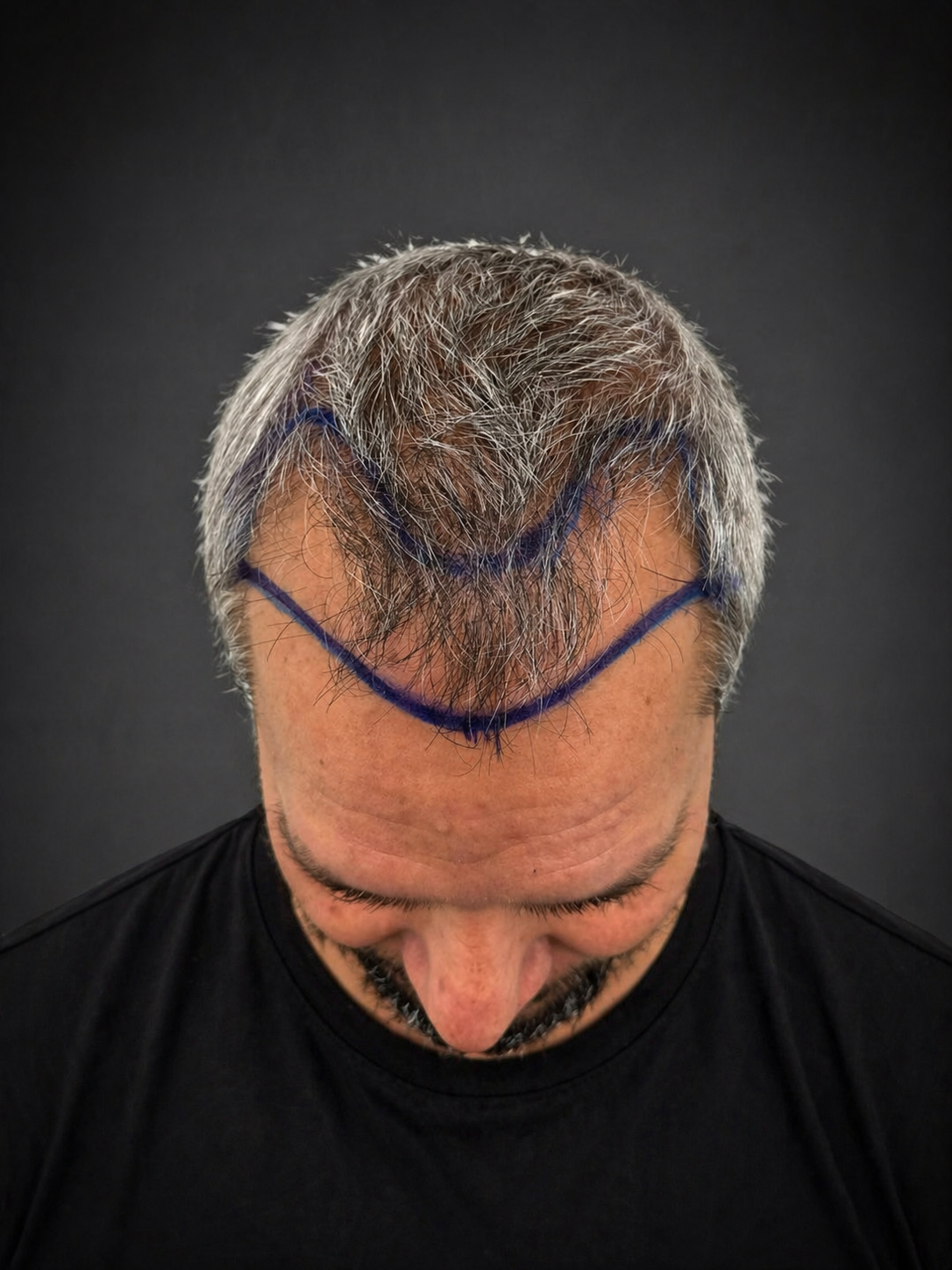 Before the hair transplant procedure