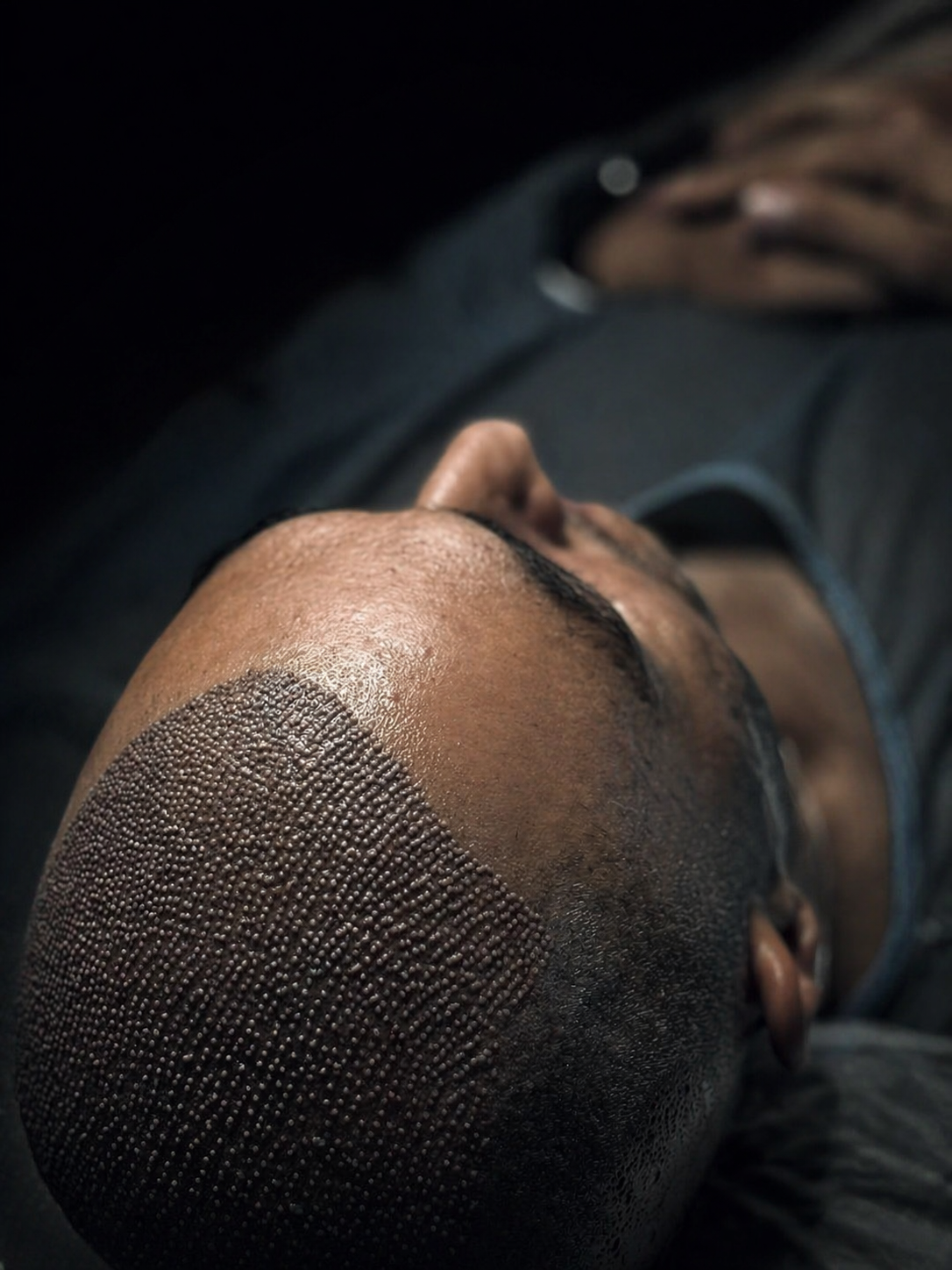 Graft placement — angle and density